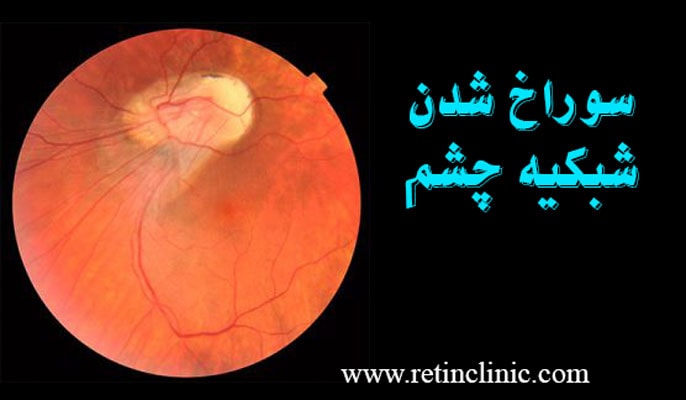سوراخ شدن شبکیه چشم