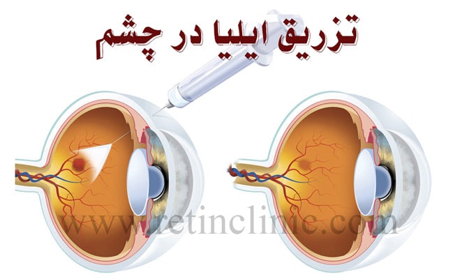 نحوه تزریق آمپول آیلیا در چشم