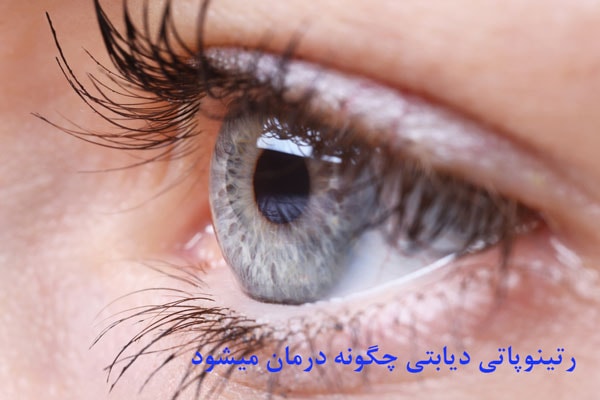 چگونگی درمان رتینوپاتی دیابتی