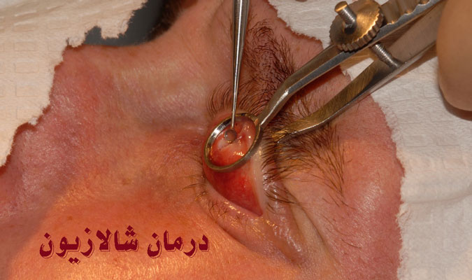 درمان شالازیون