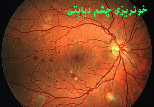 خونریزی چشم دیابتی