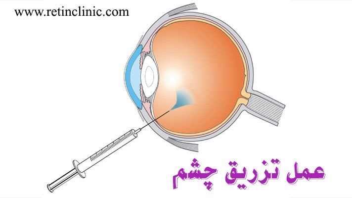 عمل تزریق چشم