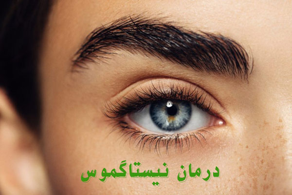 درمان قطعی نیستاگموس