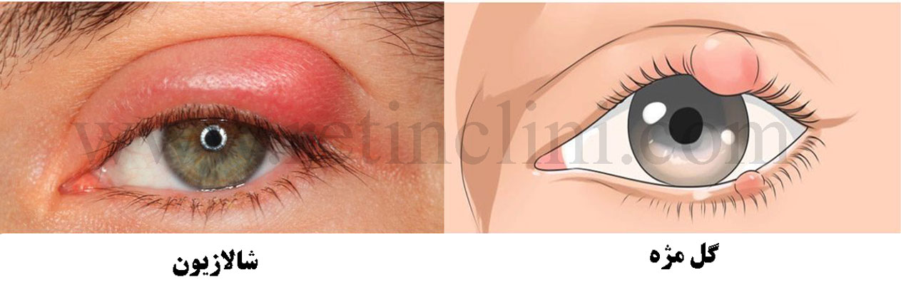 تفاوت شالازیون و گل‌مژه