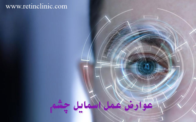 عوارض عمل اسمایل چشم