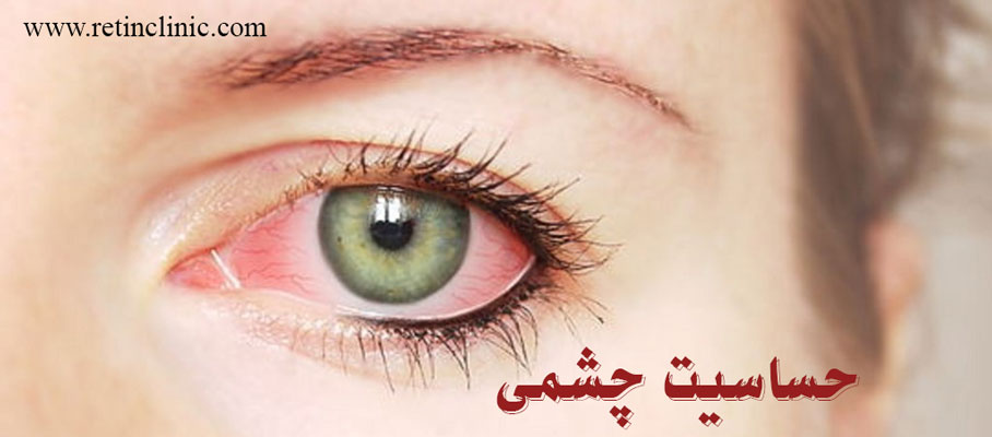 درمان حساسیت چشم