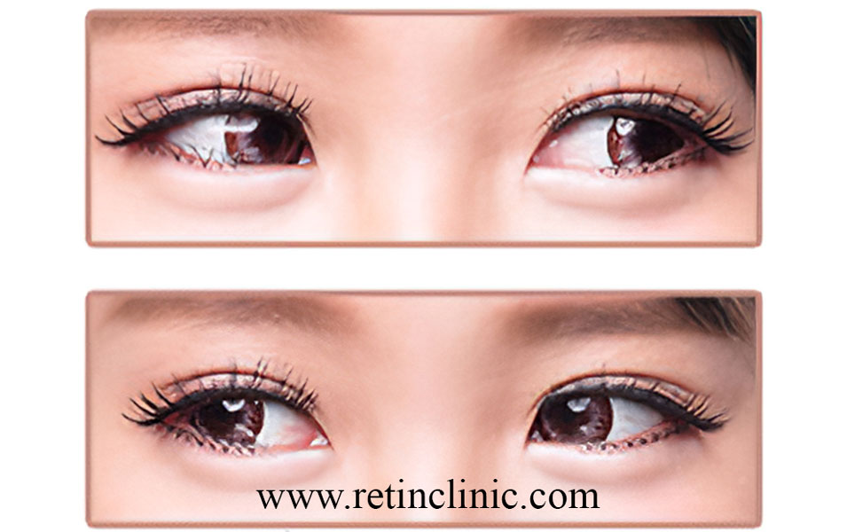 انواع لرزش چشم