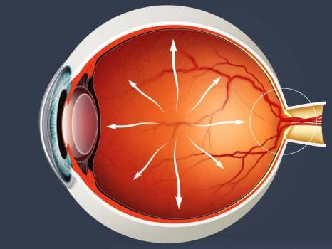 فشار چشم بالا