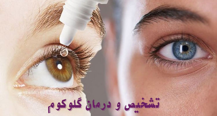 تشخیص و درمان گلوکوم