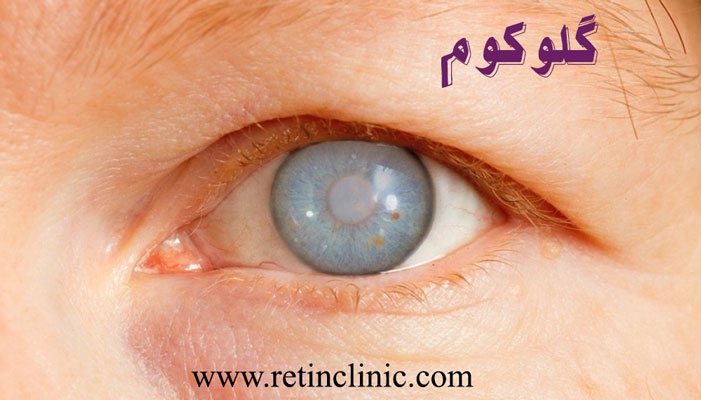 گلوکوم یا آب سیاه