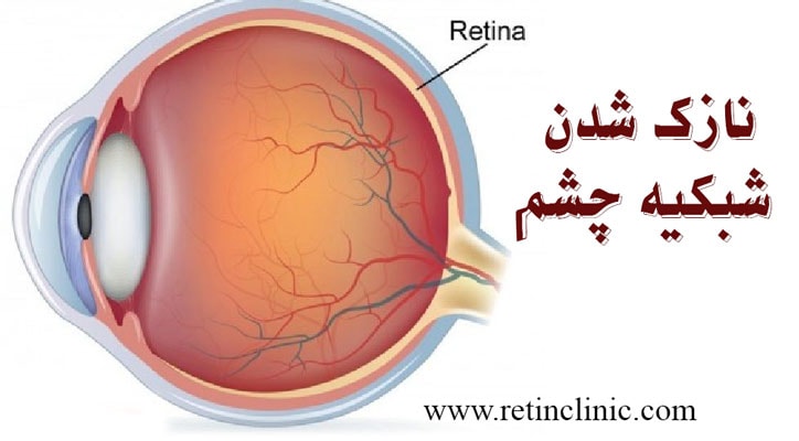 نازک شدن شبکیه چشم