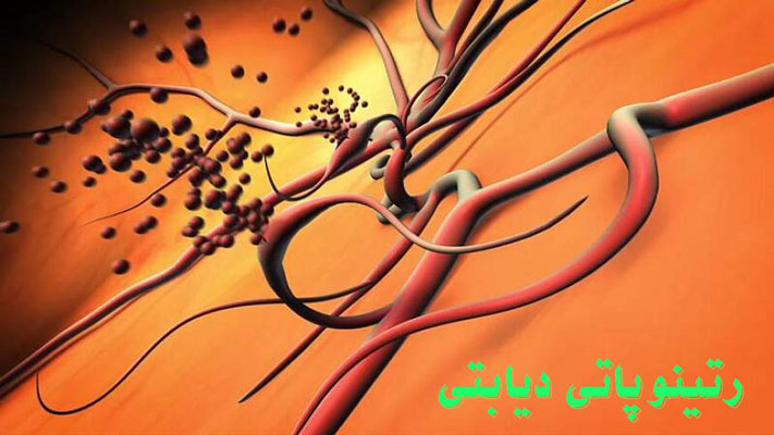 رتینوپاتی دیابتی