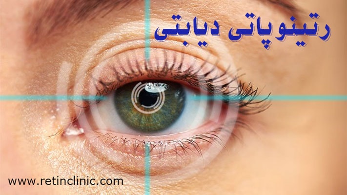 رتینوپاتی دیابتی