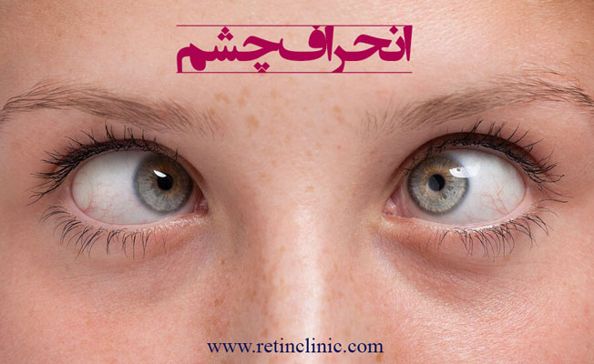 انحراف چشم