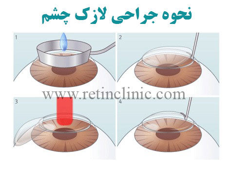 نحوه جراحی لازک چشم