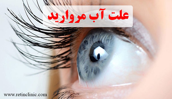 علت آب مروارید چشم