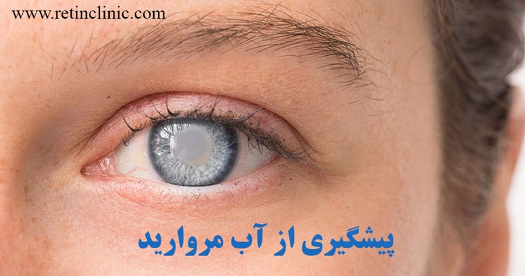 پیشگیری از آب مروارید