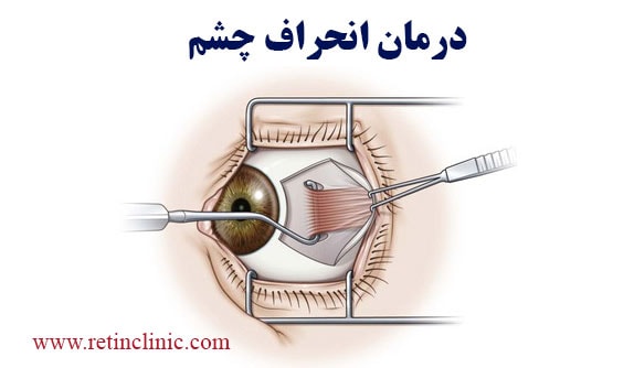 درمان انحراف چشم