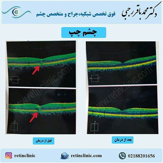 درمان تورم شبکیه