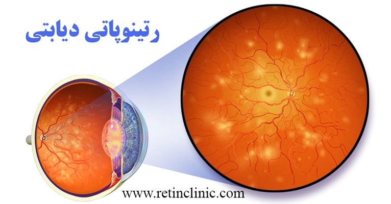 رتینوپاتی دیابتی