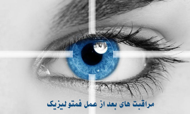 مراقبت های بعد از عمل فمتولیزیک