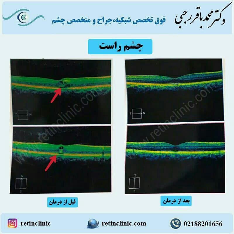 درمان تورم شبکیه