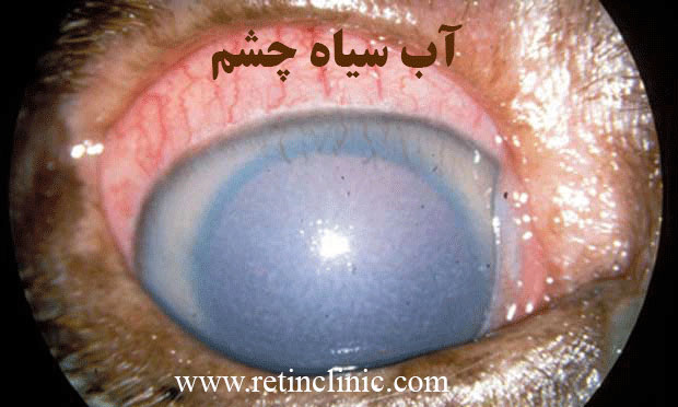 بیماری های چشمی دیابت - آب سیاه