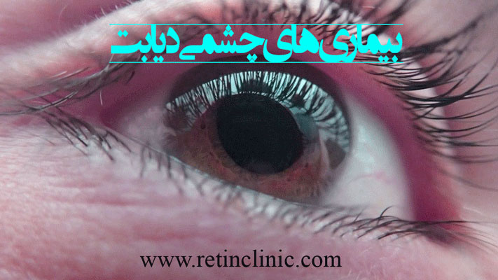 بیماری های چشمی دیابت