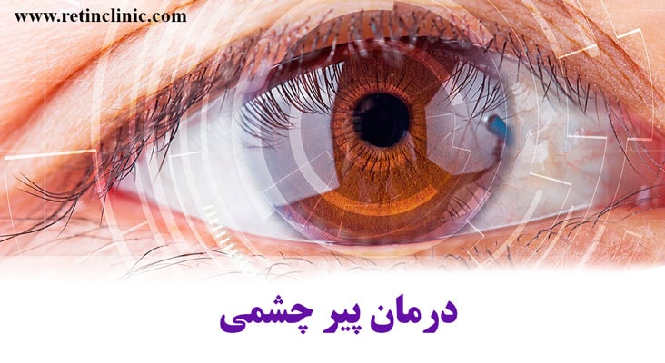 درمان پیر چشمی