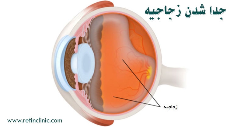 جدا شدن زجاجیه چشم