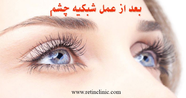 دوره نقاهت عمل شبکیه چشم