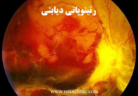 رتینوپاتی دیابتی