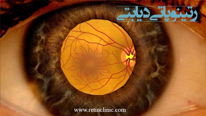رتینوپاتی دیابتی
